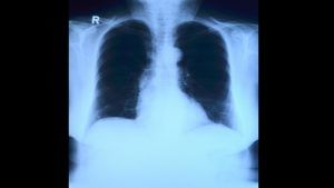 AI-driven platform to facilitate early Covid intervention over WhatsApp